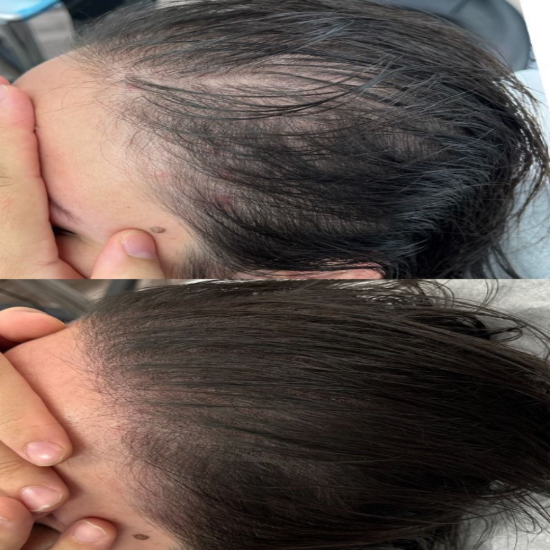 RenovaCap® Devuélvele fuerza y densidad a tu cabello