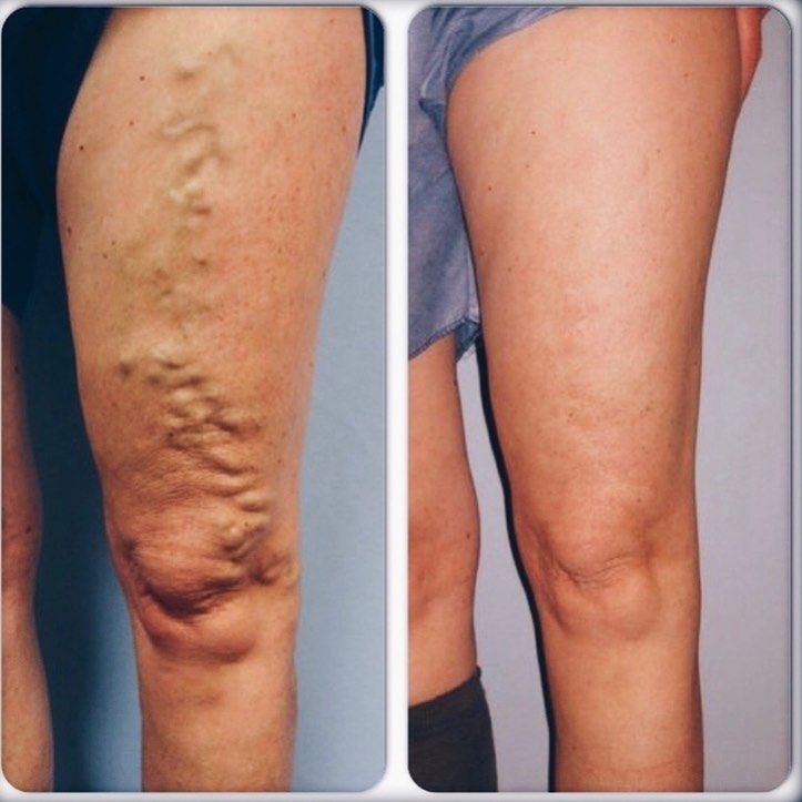 AlivioMax® | Acelera la recuperación de lesiones musculares